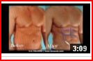 Abdominal Etching Cosmetic surgery